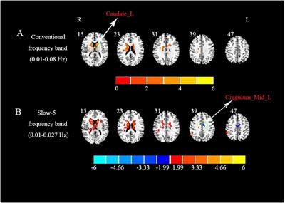 Regional homogeneity alterations in multifrequency bands in patients with basal ganglia stroke: A resting-state functional magnetic resonance imaging study